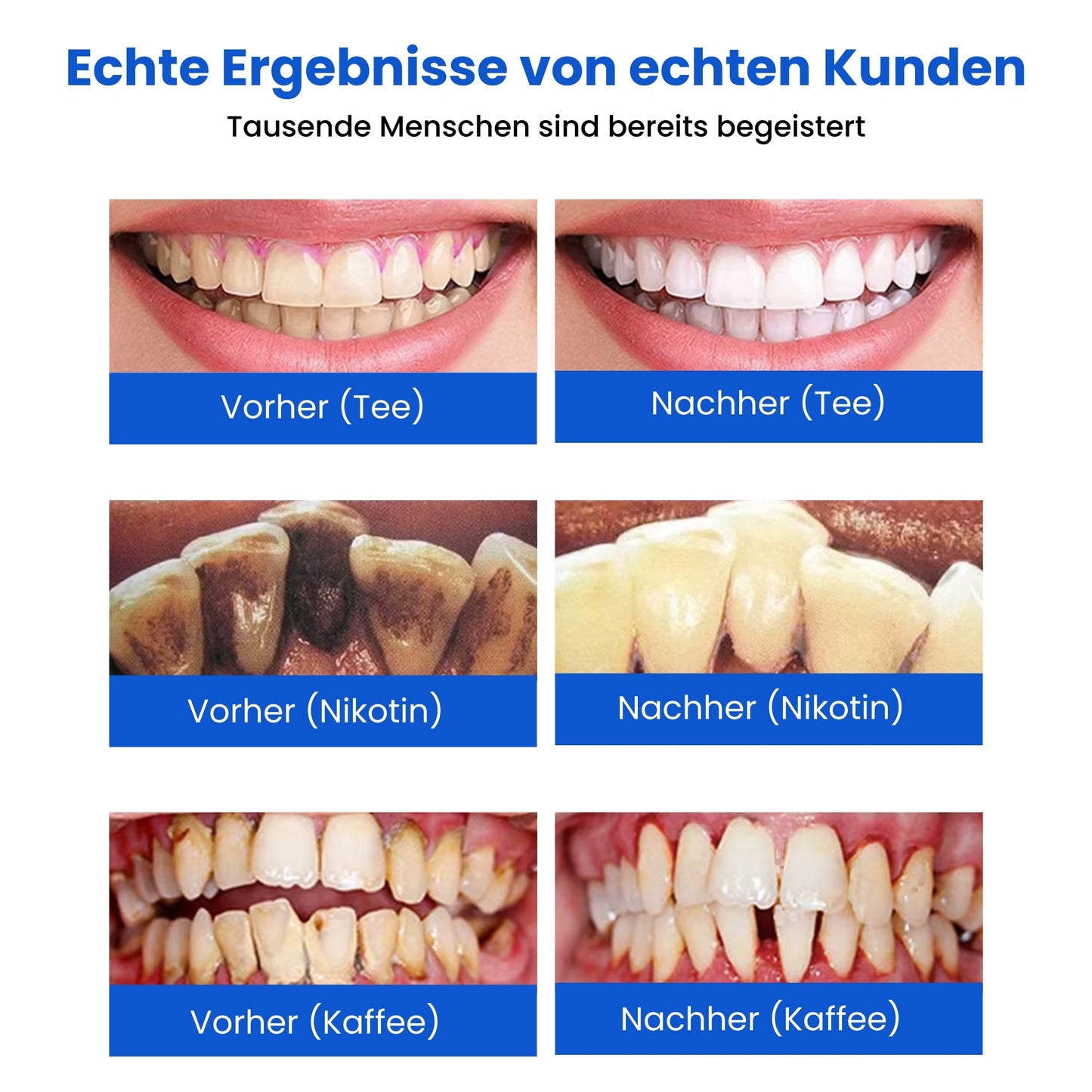 Brite Smile | Direkt weißere Zähne